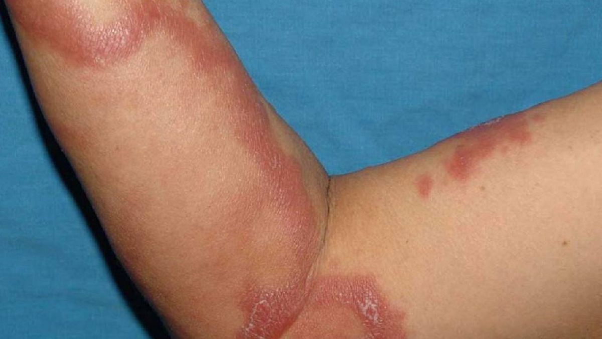 México emite una alerta sanitaria tras registrar 300 casos de lepra