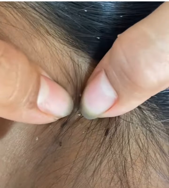 Ataca pediculosis a niñas de Nueva Rosita
