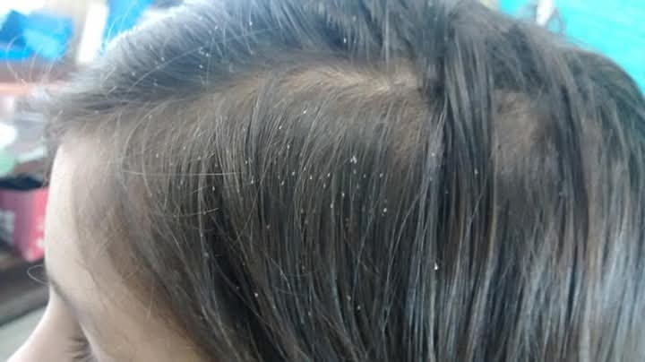Vergüenza agudiza casos de pediculosis