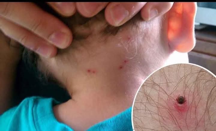 Generó alarma muerte de menor por Rickettsiosis en Nueva Rosita